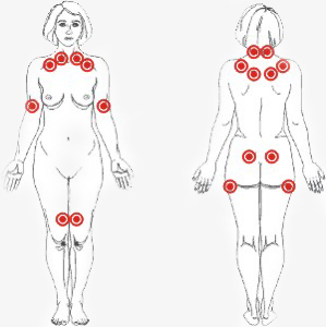puntos-fibromialgia.jpg